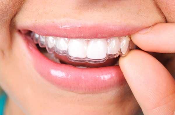 Aligners