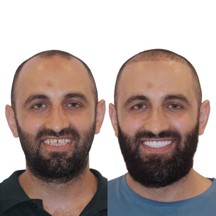 Jaafar I. Before & After