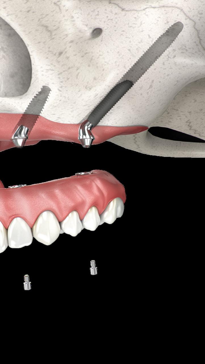 Zygoma Implant at Younes Dental Clinic, Lebanon