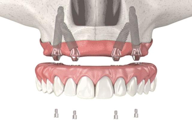 Dental Implants