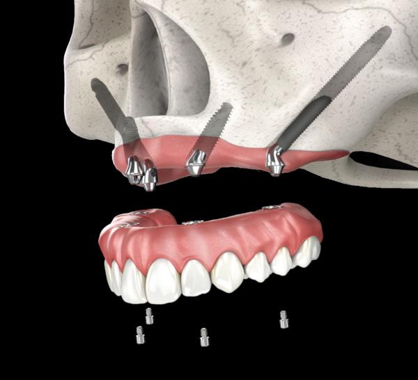 Zygoma Implant